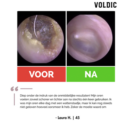 Voldic™ Elektrisch Oorreinigingsset voor Oorsmeer